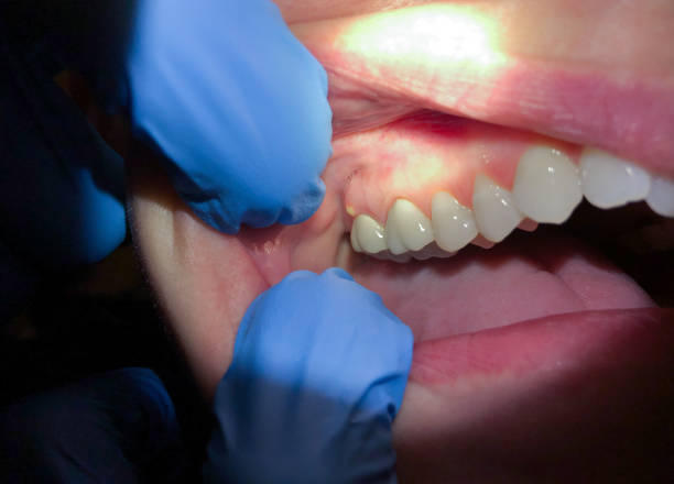 Best Emergency Wisdom Teeth Removal in Duchesne, UT
