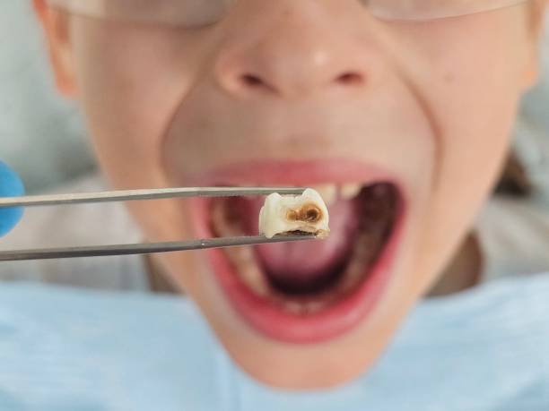 Best Emergency Dental Care for Broken or Chipped Teeth in Duchesne, UT